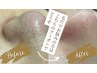 黒ずみ毛穴洗浄＆角栓吸引+ビタミンC導入+小鼻wax+パック ¥15,400→12,100
