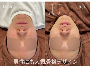アルフォービューティ 広島店(ALU FOR BEAUTY)/HIRF LIFT症例