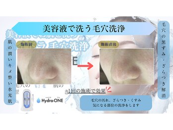 ティー(T)/ハイドラフェイシャル