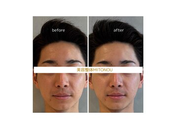 ミトノウ(MITONOU)/輪郭美人鍼ビフォーアフター