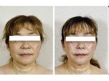 真美(Sinbi)/施術2回で！！