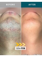 モモナ(Momona)/佐世保/脱毛/髭脱毛/全身脱毛