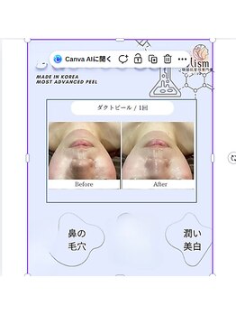 肌イズム つくば店(肌ism)/【before&after】ダクトピール