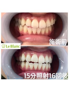 ルブラン 奈良店(Le Blanc)/月1,2回のホワイトニング！