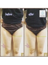 トワイル 沖縄/【インディバ部分ケア】