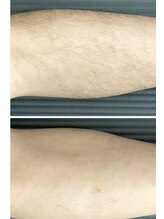 エルマナ(HERMANA)/メンズ脱毛/毛穴/vio/光脱毛