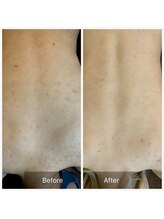 ビビ(VIVI)/背中ニキビケアハーブピーリング