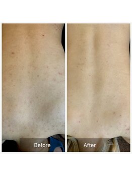 ビビ(VIVI)/背中ニキビケアハーブピーリング