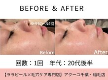 ア クーユ 稲毛店/ララピール/韓国水光ツヤ肌/美白