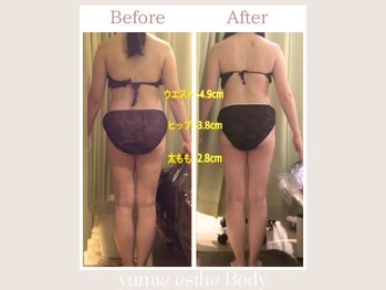 トータルビューティー ゆみえエステ(Total Beauty)/痩身 ブライダル