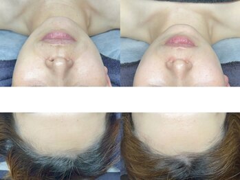 エモーショナル 姫路(Emotional)/ララピール×LDM8回の変化