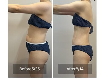 セレア(CELEA)/痩身/ダイエット/全身痩せ-8キロ