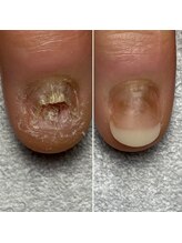 トレフル(Trefle)/痛々しい深爪が1回の施術で