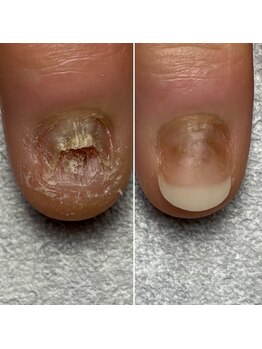 痛々しい深爪が1回の施術で