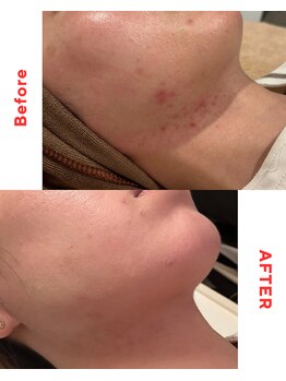 アムールドゥ 麻布十番(Amour deux)/ハーブピーリング3回