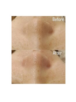 ラ メール(La mer)/★雪花ピール 毛穴★