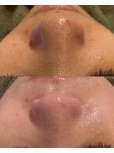 エル(Elle)/透明感アップ！毛穴黒ずみ除去