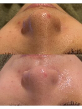 エル(Elle)/透明感アップ！毛穴黒ずみ除去