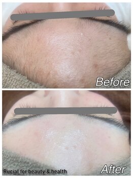 ルシアル(Rucial)/白玉ワックス◇Before／After