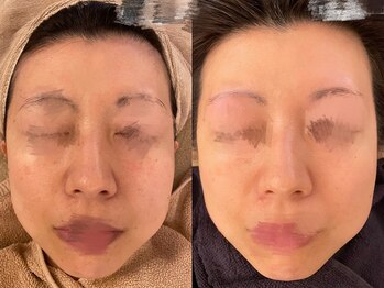 スターラッシュ(Star Lash)/全顔美肌脱毛1回◎施術前後