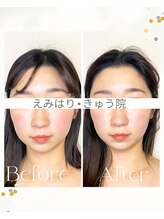 えみはりきゅう院/フェイスラインすっきり美容鍼♪