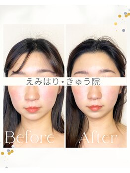 えみはりきゅう院/フェイスラインすっきり美容鍼♪