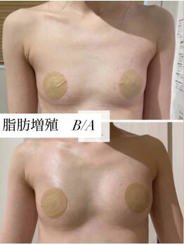 ミセルビューティー 御堂筋本町(micell beauty)/脂肪増殖 バストアップ