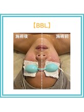 トッコ 那須塩原店(tocco)/BBL光フェイシャル