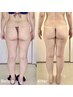 【徹底美脚】《むくみ/ヒップアップ/セル脂肪》高周波カッピング×痩身コルギ