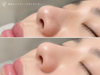 東京ビューティースキンセンター 新宿店/毛穴の奥から徹底洗浄