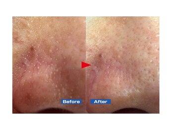 ニュイブラーシュ(nuit blanche)/汚らしい角栓も♪