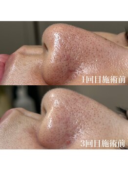 フレーズ(fraise)/なんとどちらも施術前なんです。