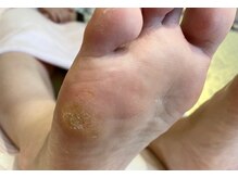 ビサンテ サロン/酷い魚の目・たこに角質ケア-1