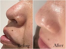 アンベリール(embellir.)/毛穴洗浄コース