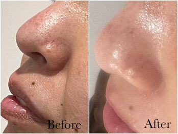 アンベリール(embellir.)/毛穴洗浄コース