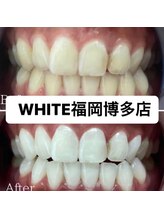 ホワイト 福岡博多店(WHITE)/ホワイトニング通い放題ビフォー