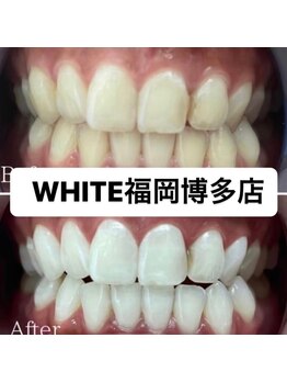 ホワイト 福岡博多店(WHITE)/ホワイトニング通い放題ビフォー