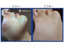 メンズ脱毛サロン アカラ(AKALA)/ヒゲ脱毛のビフォーアフター