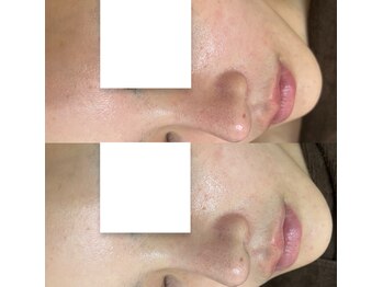 ベリスユイット(BELLIS HUIT)/【剥離なしハーブピーリング】