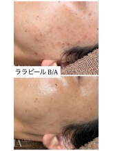 ミセルビューティー 御堂筋本町(micell beauty)/ララピール