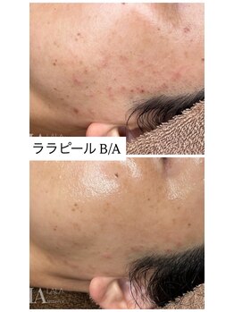 ミセルビューティー 御堂筋本町(micell beauty)/ララピール