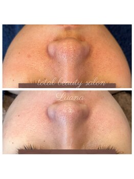 ルアナ 柏本店(LUANA)/毛穴/ざらつき/赤み/改善例