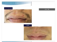 ディシェーレ アスト/ヒゲ脱毛