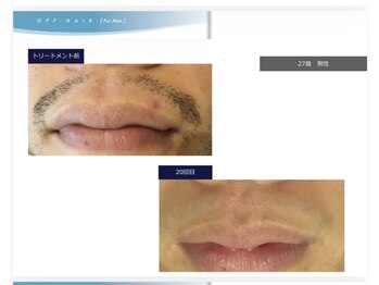 ディシェーレ アスト/ヒゲ脱毛