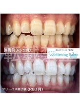 ホワイトニングサロン 福岡天神店/ホワイトニング