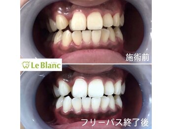 ルブラン 奈良店(Le Blanc)/簡単なセルフホワイトニング