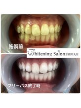 ホワイトニングサロン 京都烏丸店/ホワイトニング施術例