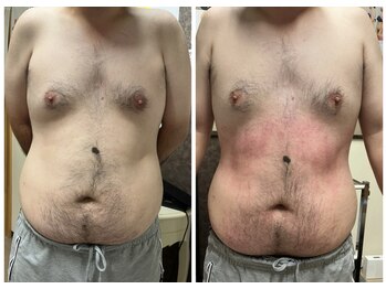 スマイルボディ つぼの森 吉野店(Smile body)/メディセルお腹集中!