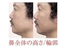 ラプリ 銀座店(Raplit)/隆鼻＋輪郭矯正40分20回
