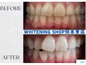 ホワイトニングショップ熊本東店/ホワイトニングショップ熊本東店